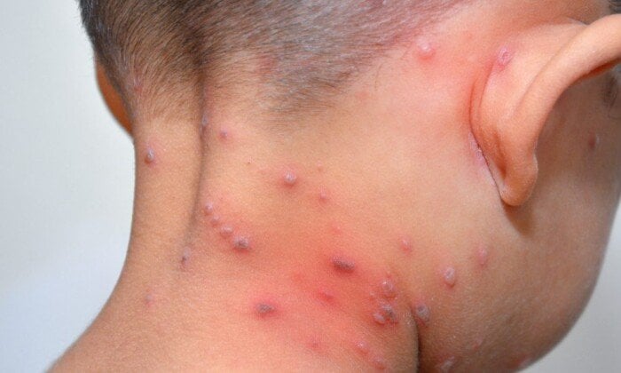 تعليم المنوفية: الأوضاع آمنة بمدارس المنوفية بعد السيطرة على حالات الجدري السابقة